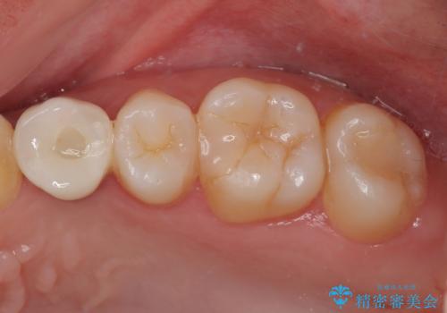 根元から折れてしまった歯をどうする?矯正かインプラントかを比較検討した症例の症例 治療後