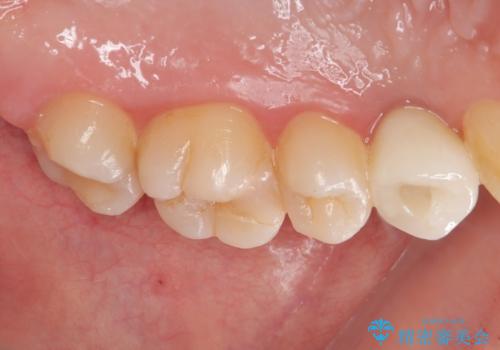 根元から折れてしまった歯をどうする?矯正かインプラントかを比較検討した症例の治療後