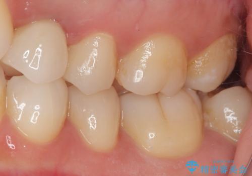 根元から折れてしまった歯をどうする?矯正かインプラントかを比較検討した症例の治療後