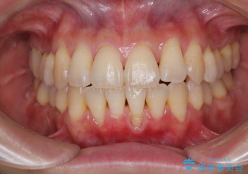 前歯のデコボコをインビザラインで目立たずに改善の治療中