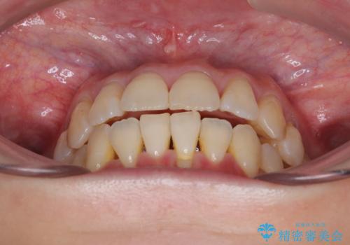 前歯のデコボコをインビザラインで目立たずに改善の治療中