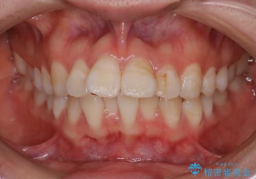 【審美装置】口元を下げたい