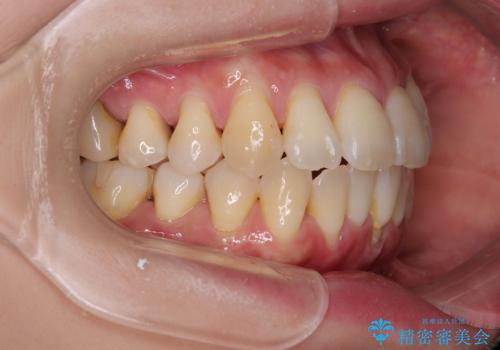 前歯のデコボコをインビザラインで目立たずに改善の治療中