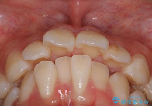 【審美装置】口元を下げたいの治療前