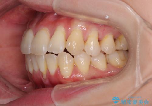 前歯のデコボコをインビザラインで目立たずに改善の治療中