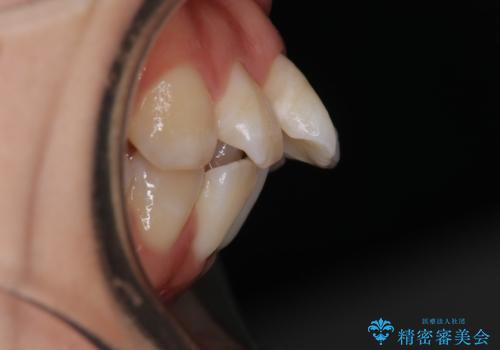 【審美装置】口元を下げたいの治療前