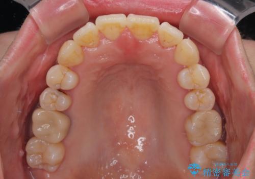 前歯のデコボコをインビザラインで目立たずに改善の治療中