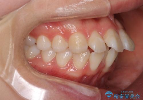 【審美装置】口元を下げたいの治療前