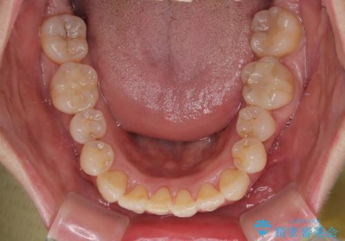 前歯のデコボコをインビザラインで目立たずに改善の治療中