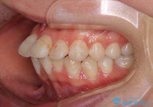 【審美装置】口元を下げたいの治療前