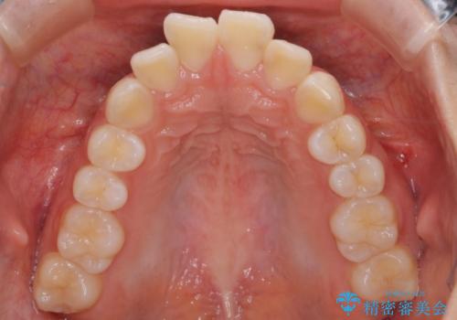 【審美装置】口元を下げたいの治療前