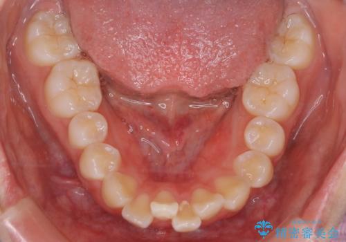 【審美装置】口元を下げたいの治療前