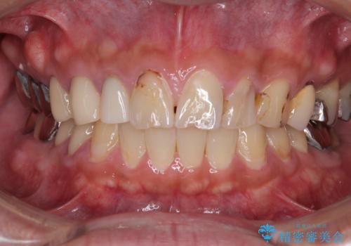 前歯のコンプレックスを解消|40代男性・オールセラミッククラウン症例の治療前