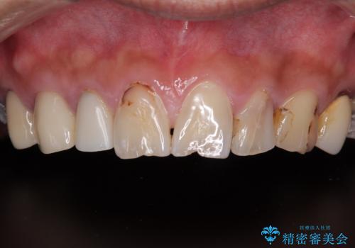 前歯のコンプレックスを解消|40代男性・オールセラミッククラウン症例の治療前