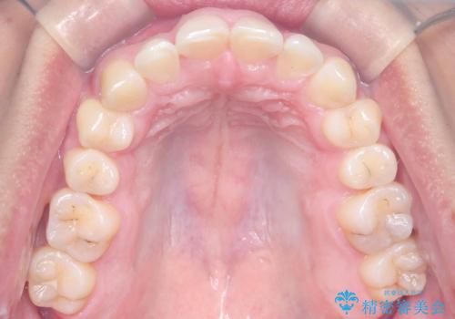 デコボコも深いかみ合わせも…“全部気になる”を一気に解決の治療後