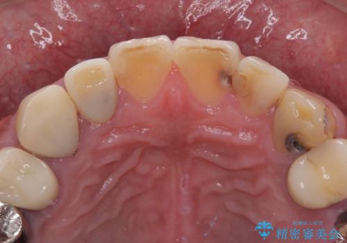 前歯のコンプレックスを解消|40代男性・オールセラミッククラウン症例の治療前