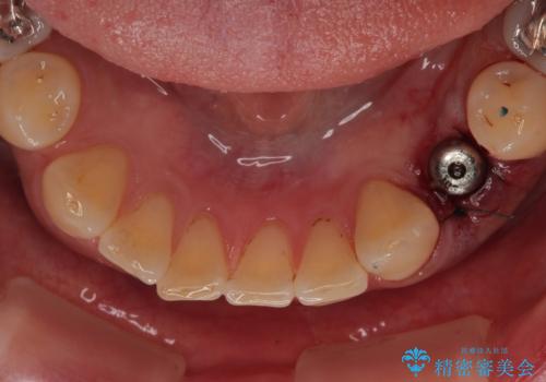 ぐらつく乳犬歯を抜歯即時インプラントで短期間に機能回復の治療中