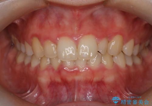 【インビザライン】がたつきを綺麗にしたいの治療前