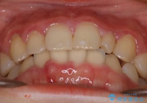 【インビザライン】がたつきを綺麗にしたいの治療前