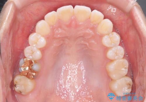 「歯を抜かずに、たった10ヵ月。」目立ちにくい大人の矯正の治療後