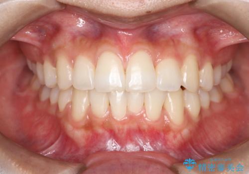 1年でここまで変わる。デコボコ歯並びの非抜歯矯正!の治療後