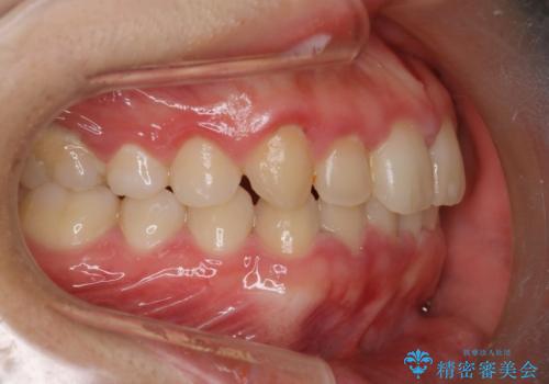 【インビザライン】がたつきを綺麗にしたいの治療前