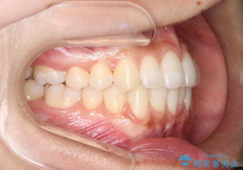 1年でここまで変わる。デコボコ歯並びの非抜歯矯正!の治療後