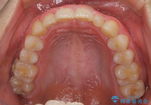 【インビザライン】がたつきを綺麗にしたいの治療前