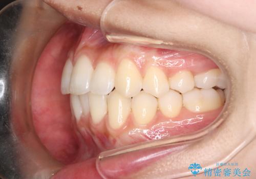 1年でここまで変わる。デコボコ歯並びの非抜歯矯正!の治療後