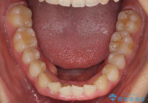 【インビザライン】がたつきを綺麗にしたいの治療前