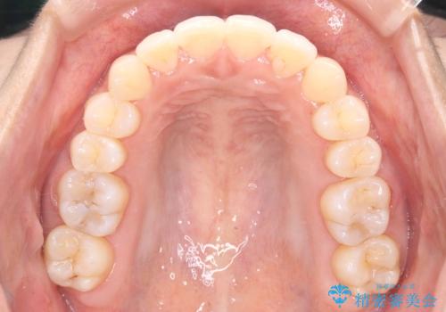 1年でここまで変わる。デコボコ歯並びの非抜歯矯正!の治療後