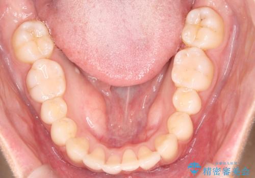 1年でここまで変わる。デコボコ歯並びの非抜歯矯正!の治療後