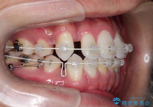 前歯の突出を防ぎながらガタつきを解消。上下左右4番抜歯による審美ワイヤー矯正の治療中