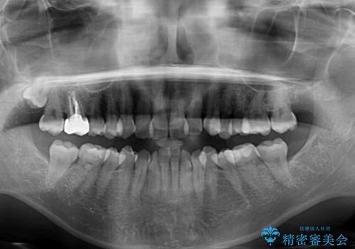 前歯のデコボコをインビザラインで目立たずに改善の治療前