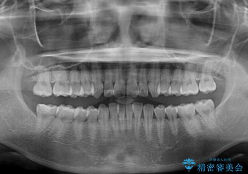 飛び出した前歯を引っ込める　ワイヤー装置の非抜歯矯正の治療前