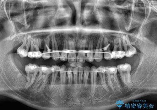矯正治療途中で転院　遠方への転勤で通院困難な方の矯正治療の治療前
