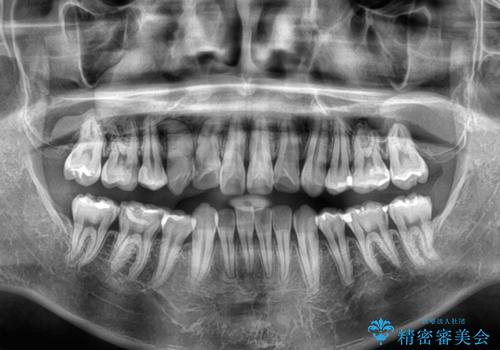 矯正治療の後戻り　インビザライン・モデレートパッケージで短期間治療の治療前