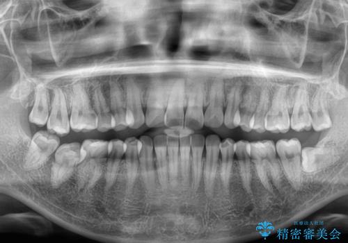 インビザラインの自己管理は煩わしい　ワイヤー矯正で短期間矯正治療の治療前