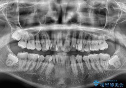 八重歯と重なった前歯　目立たない装置での抜歯矯正の治療前