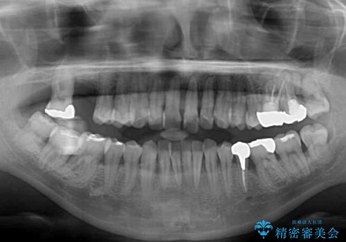 かかりつけ医の治療方針に疑問　歯周病治療と矯正治療を合わせた総合歯科治療の治療前