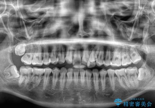 急速拡大装置 狭い上顎歯列を改善して、八重歯を改善した片側抜歯矯正治療の治療前