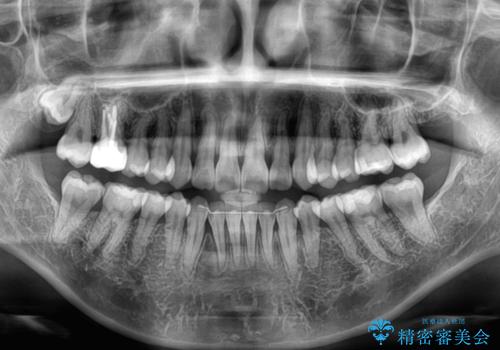前歯のデコボコをインビザラインで目立たずに改善の治療後