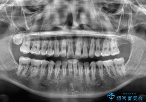 急速拡大装置 狭い上顎歯列を改善して、八重歯を改善した片側抜歯矯正治療の治療後