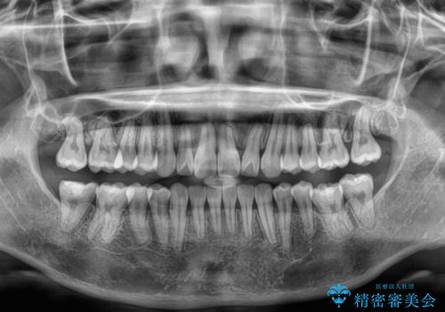 飛び出した前歯を引っ込める　ワイヤー装置の非抜歯矯正の治療後