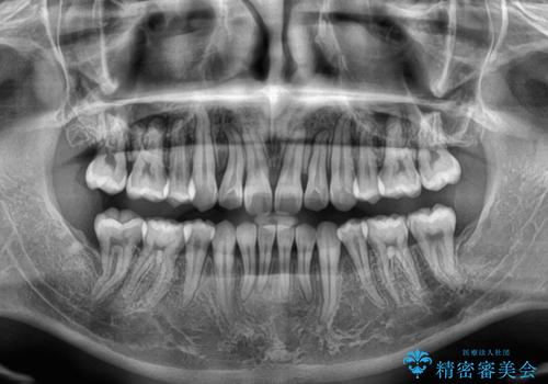 矯正治療途中で転院　遠方への転勤で通院困難な方の矯正治療の治療後