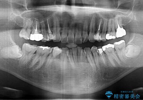 全ての銀歯を外すメタルフリー治療 + 歯並びをきれいにする矯正治療の治療前