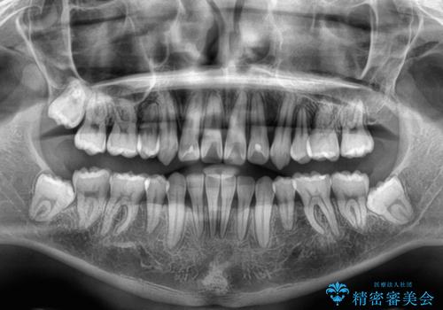八重歯と重なった前歯　目立たない装置での抜歯矯正の治療後