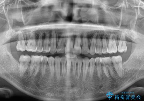 インビザラインの自己管理は煩わしい ワイヤー矯正で短期間矯正治療の治療後