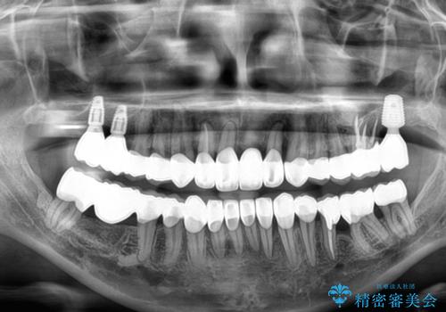 かかりつけ医の治療方針に疑問　歯周病治療と矯正治療を合わせた総合歯科治療の治療後