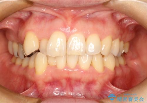 目立たないマウスピースで八重歯を解消。右上5番の抜歯スペースを活用したインビザライン矯正